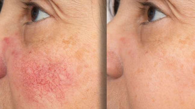 Serolia - Suero Anti-Rojeces
